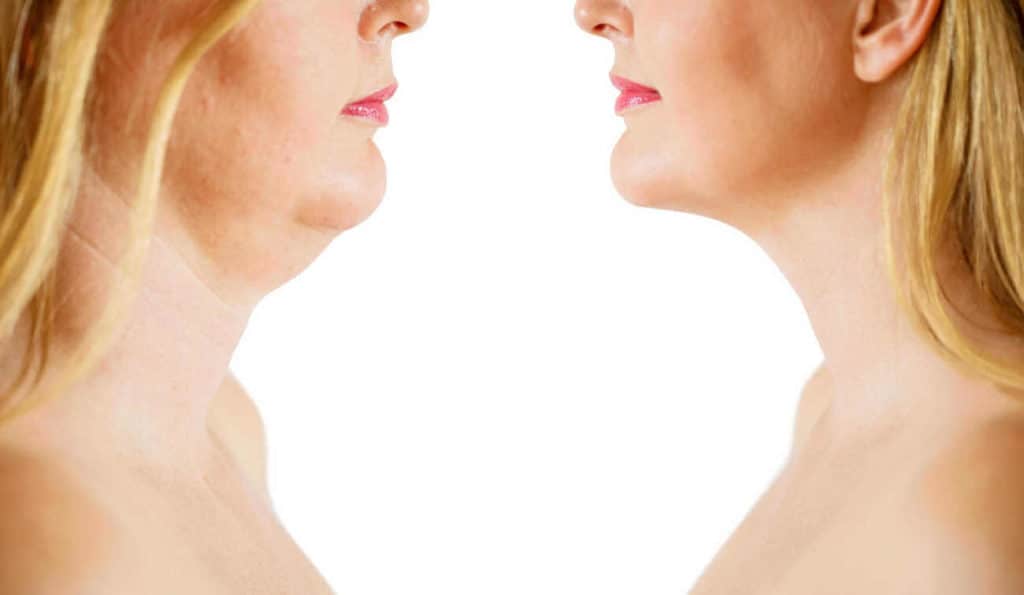 Double Chin treatment Fareham before and after results