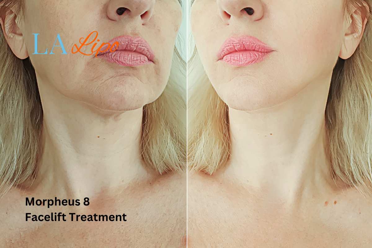 Turn back time with Morpheus8 Treatment Fareham