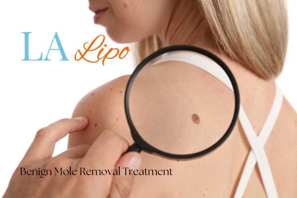 Why getting moles removed Fareham can boost your confidence!