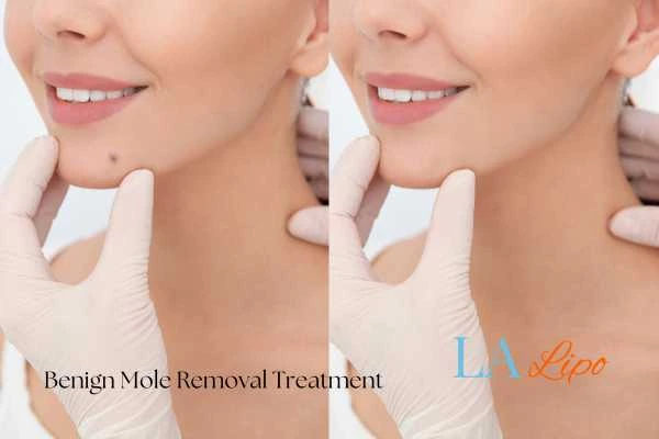 Woman's before and after results of being moles removal treatment Fareham