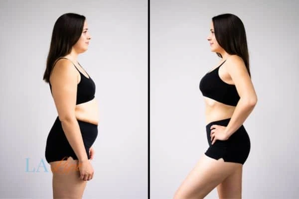 LA-EMS Body Sculpting Fareham results before and after of womans results on body toning.