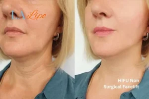 hi-fu for wrinkles Fareham before and after results