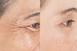 Before and after results of woman - HI-fu wrinkles reduction treatment Fareham