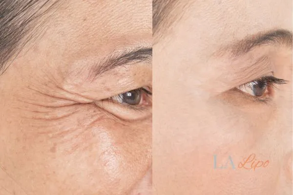 Before and after results of woman - HI-fu wrinkles reduction treatment Fareham