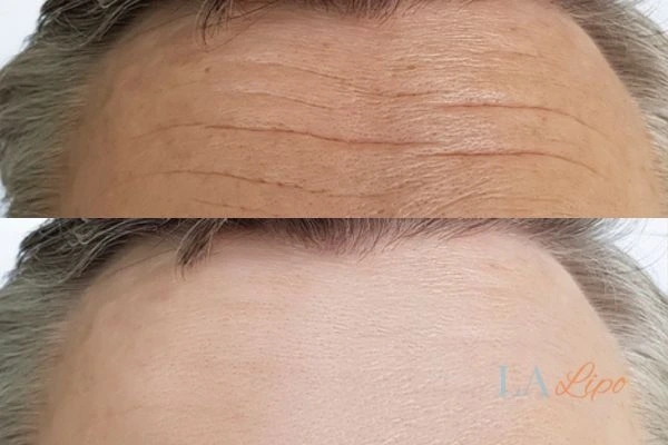 results of HIFU Fareham on mans forehead to help reduce lines and wrinkles