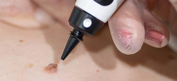 skin tag removal using cryopen Fareham