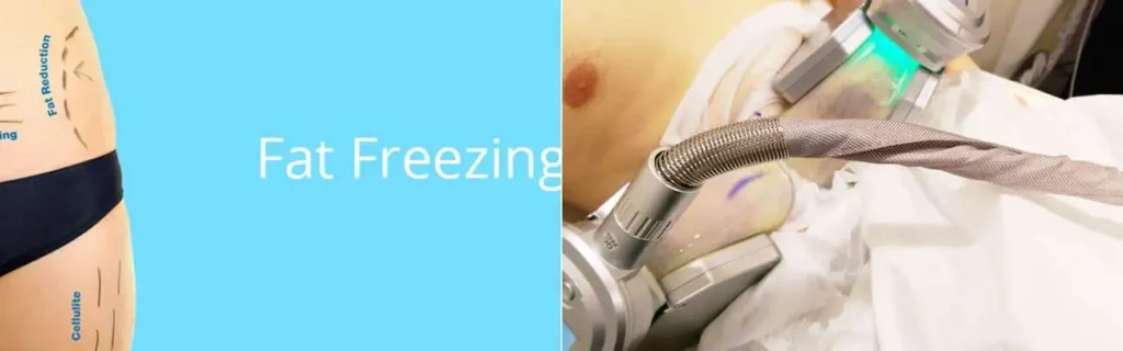multi areas of a persons body having coolsculpting Fareham treatment
