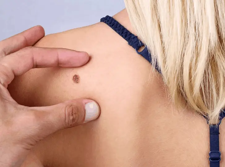 woman having mole removal Fareham consultation before treatment.