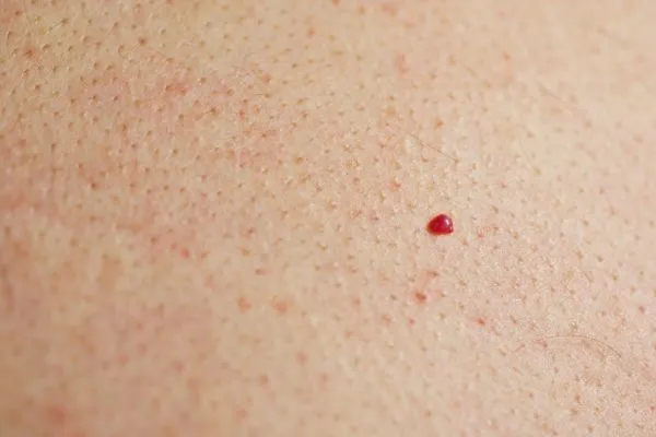 close up of a cherry angioma Fareham