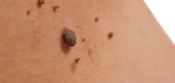 image of a skin tag Fareham