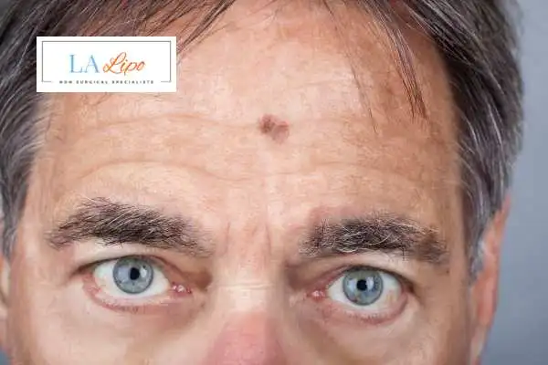 Solar Lentigo Removal Fareham image of man with mark on his forehead