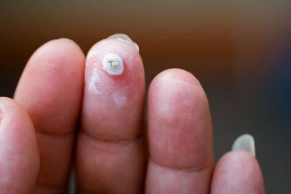 wart on person finger - cryotherapy to treat from LA LIPO Fareham