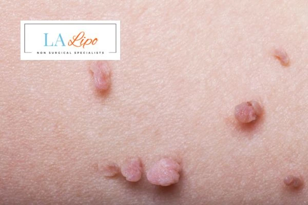 Does cryopen skin tag removal Fareham hurt? Find out now call our team today!