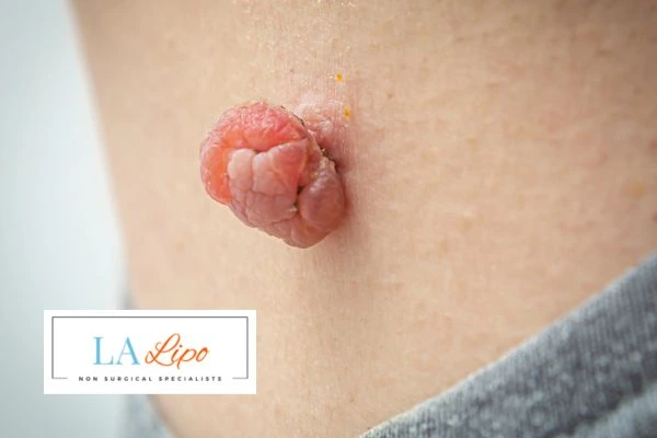 Interested in skin tag removal Fareham? Concerned about the pain? Find out more today!