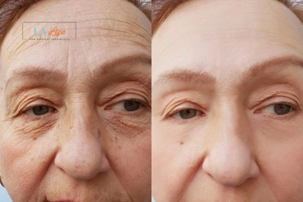 The powerful benefits of Morpheus8 Treatment Fareham - Call Our team today!