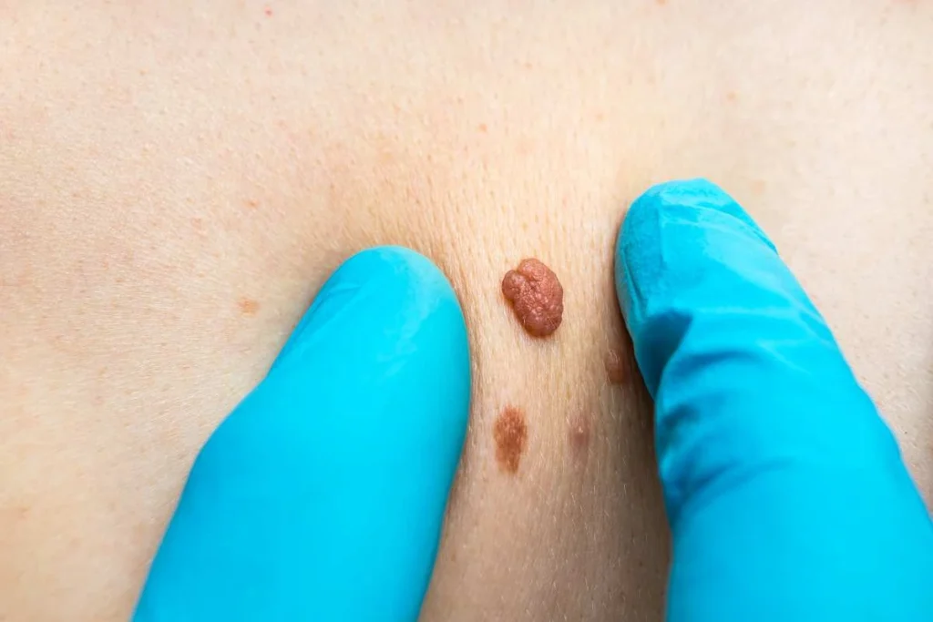 LA LIPO Cryopen Lesion Removal Prices Fareham