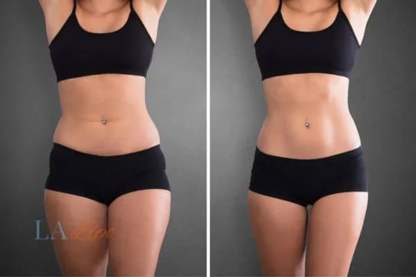 before and after results of non-surgical treatment to help a woman's body image and mental health Fareham