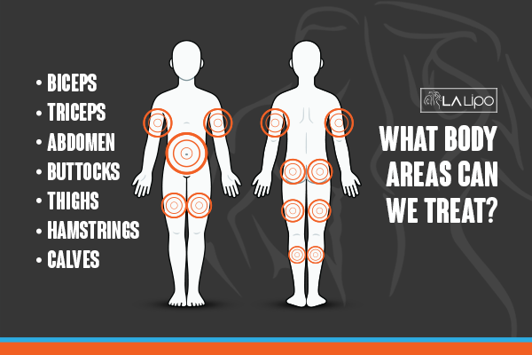 Diagram to show areas you can have LA-EMS Body Sculpting Treatment Fareham