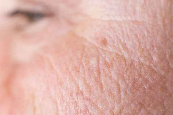close up picture of a woman's face showing an age spot Fareham