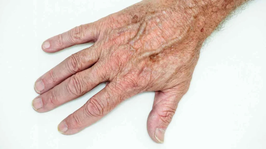 Male hand showing age spot Fareham