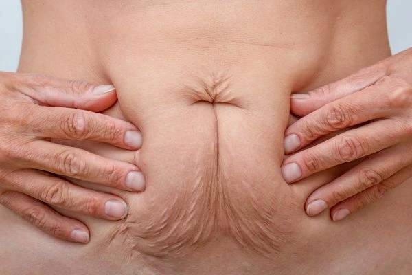 Image of a woman's stomach with loose skin - example of skin tightening Fareham options